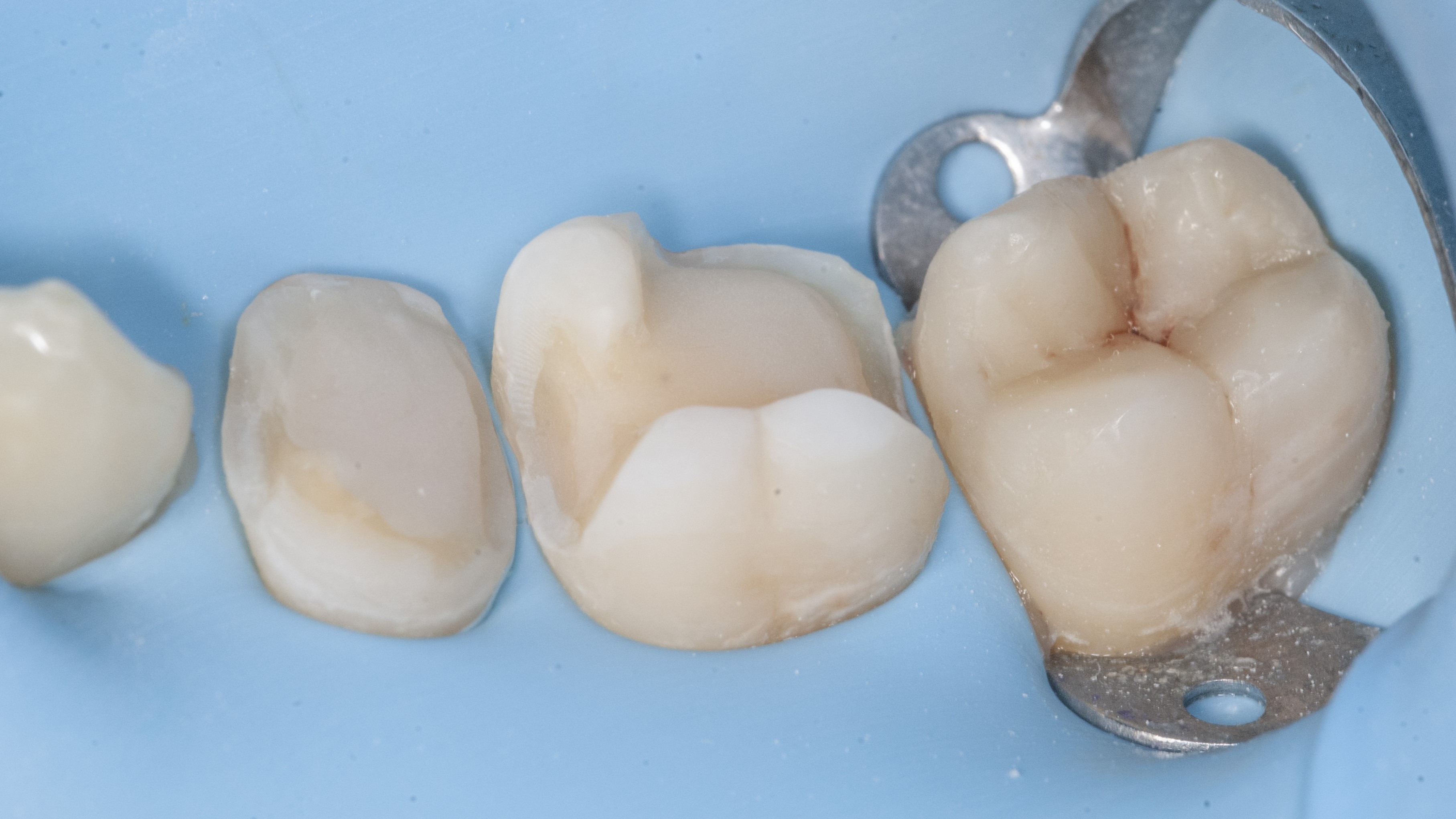 Why do we recommend a Ceramic Onlay?
